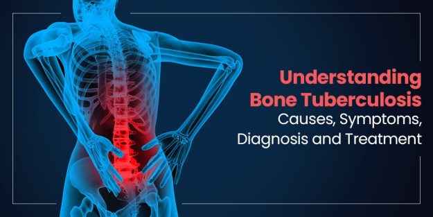 Understanding Bone Tuberculosis: Causes, Symptoms, Diagnosis, and Treatment