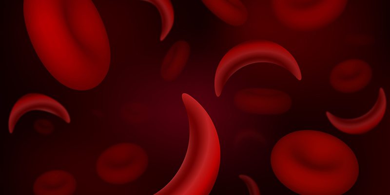 Sickle Cell Disease Sickle Cell Disease