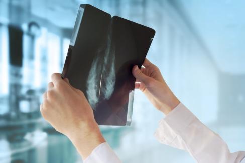 mammography